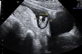 Image result for 13 Week Baby Ultrasound