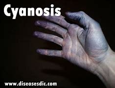 Image result for Cyanosis