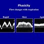 Image result for Nonphasic Venous Flow