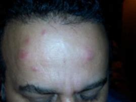 Image result for Bed Bug Bite On Eye