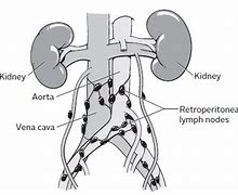 Image result for Retrocaval Surter Radiology