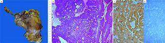 Image result for Gross Pathology Bladder Specimen