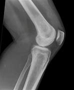 Image result for Lateral View of Knee Joint