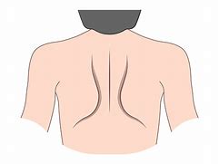 Image result for Winged Scapula Causes