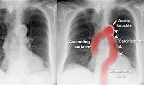 Image result for Aortic Rupture CXR