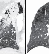 Image result for Distal Acinar Emphysema