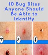 Image result for Different Bug Bites