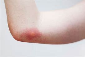 Image result for Treating Insect Bites