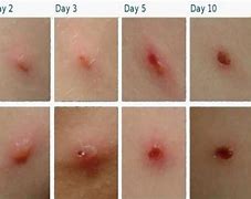 Image result for Pox Scratch