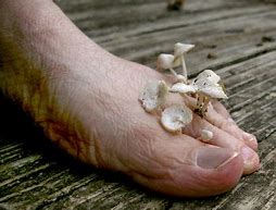 Image result for Toes with Fungus