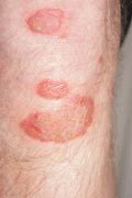 Image result for Red Flat Skin Lesion