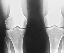 Image result for Patellofemoral Joint Space Narrowing