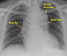 Image result for Aortic Rupture CXR