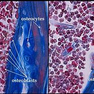 Image result for Ostrisos Bone Cells