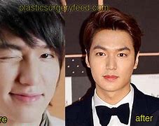 Image result for Lee Min Ki Plastic Surgery