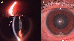 Image result for HLA Gene Uveitis