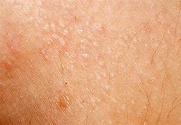 Image result for Allergic Reaction with Pustules