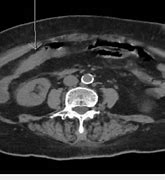 Image result for CT Angiogram Abdomen