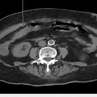 Image result for CT Angiogram Abdomen