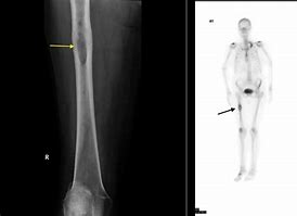 Image result for DDR and Bone Metastasis