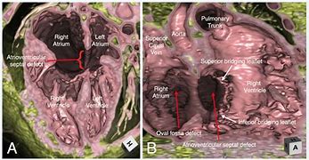 Image result for Atrioventricular Septum