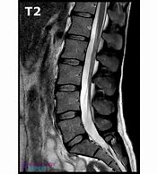 Image result for Lumbar Spine MRI 8Mm