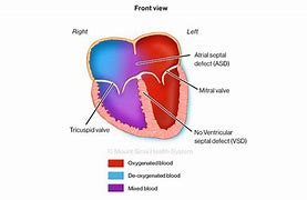 Image result for AV Canal Defect Down Syndrome