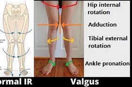 Image result for Lateral Knee Pain with Internal Rotation