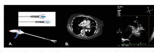 Image result for Thoracoscopic Left Atrial Appendage Clipping