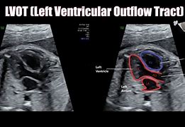 Image result for Rvot and LVOT Fetal Ultrasound Images Colour