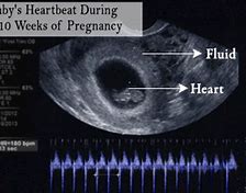 Image result for Abnormal Fetal Heart Ultrasound