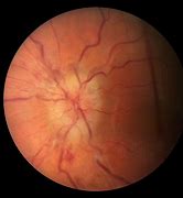 Image result for Papilledema