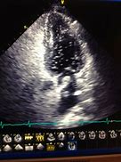 Image result for Septal Aneurysm