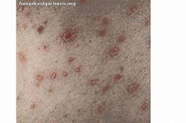 Image result for Heat Rash Fungal Infection