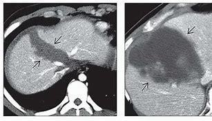 Image result for Biloma Ultrasound Images Post-Cholecystectomy