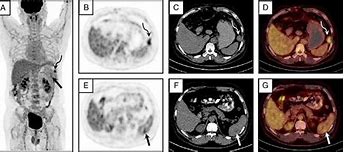 Image result for Spleen Metastasis