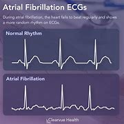 Image result for AFib vs V-fib