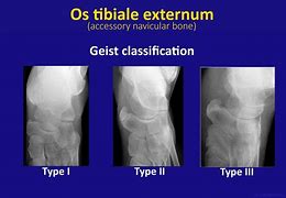 Image result for OS Tibiale Externum