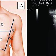 Image result for Pulmonary Regurg Ultrasound Flame