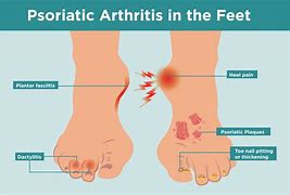 Image result for Psoriatic Arthritis