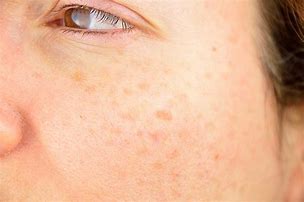 Image result for Black Spots On Skin Means