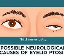 Image result for Liver Ptosis