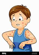 Image result for Rashes Clip Art