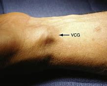 Image result for Volar Wrist Cyst