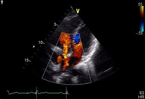 Image result for Septal Aneurysm