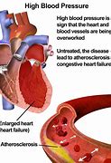 Image result for High Blood Pressure Cardiovascular Disease