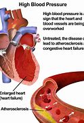 Image result for High Blood Pressure