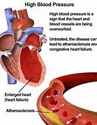 Image result for High Blood Pressure Arteries