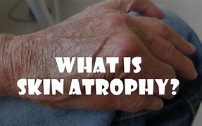 Image result for Sclerotic Atrophy of Skin