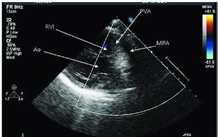 Image result for Infundibulum Nose